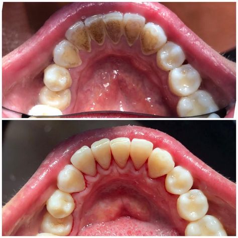 Fillings & Restorations